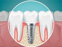 Implant Dentistry