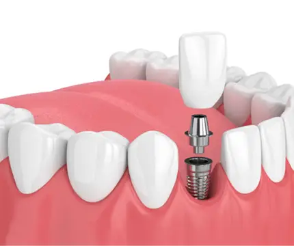 Dental Implant