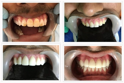 Dental Veneers