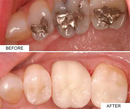 Tooth Coloured Fillings